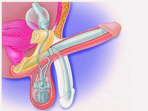 Penis enlargement with a penis prosthesis