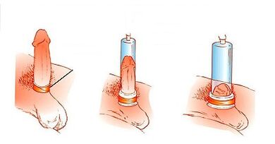 Principle of pump operation for pennis increase